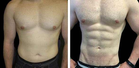 Laser and EMS Body Sculpt Before and After