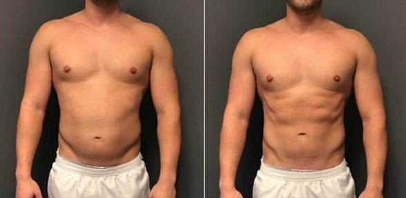 Laser and EMS Body Sculpt Before and After