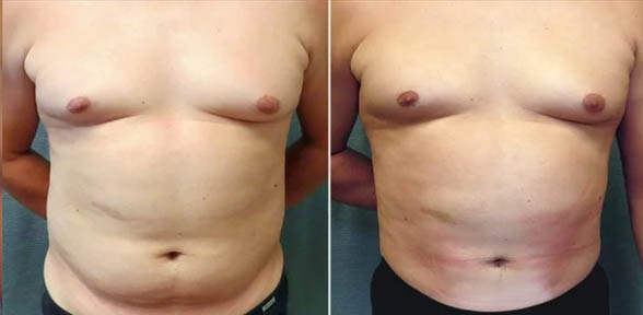 Fat Freezing Before and After 2