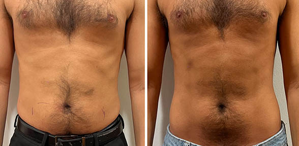 Fat Freezing Before and After