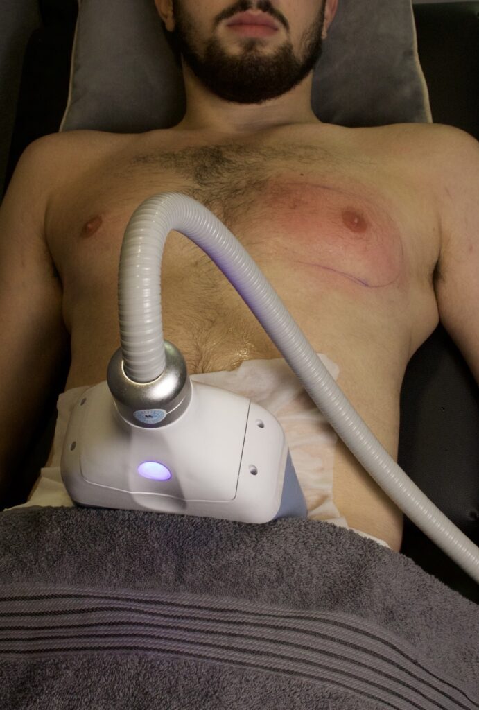 Fat Freezing