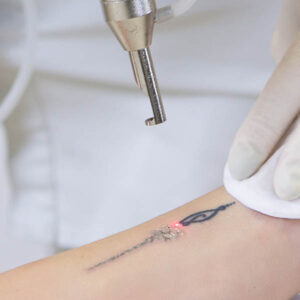 Picoway Laser Tattoo Removal