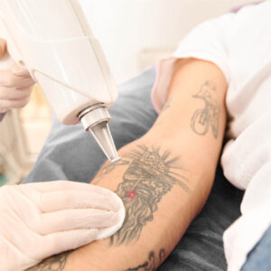Picoway Laser Tattoo Removal