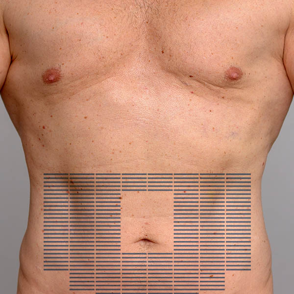 Abdomen tightening